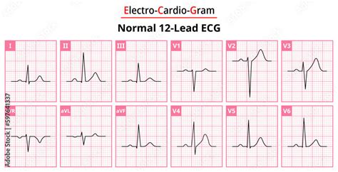 normal ecg 12 lead|Iba pa.